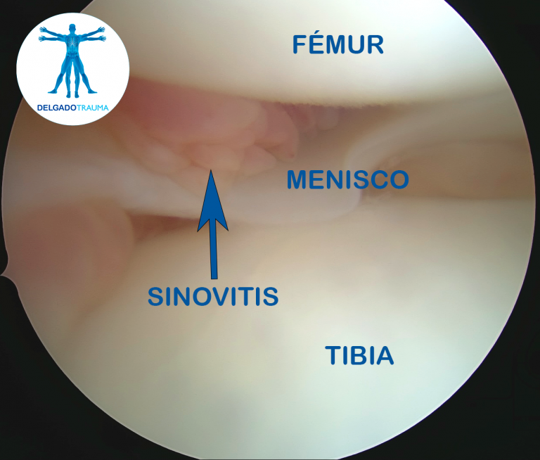 Artroscopia Rodilla Dr Delgado DELGADOTRAUMA