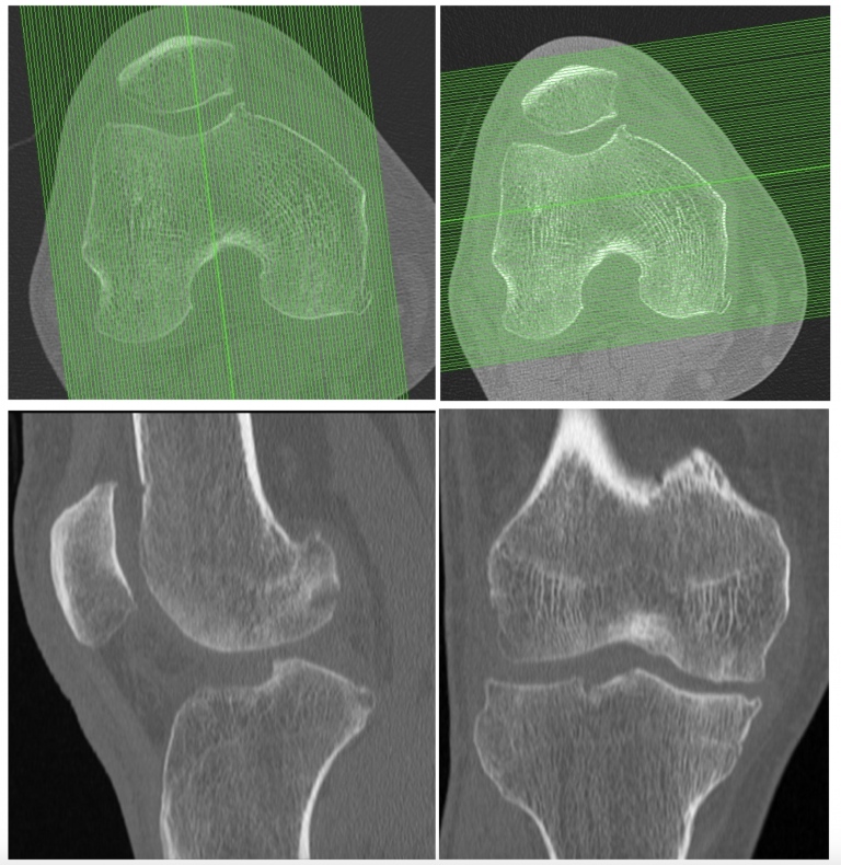 Pr Tesis De Rodilla Personalizada A Medida Delgadotrauma